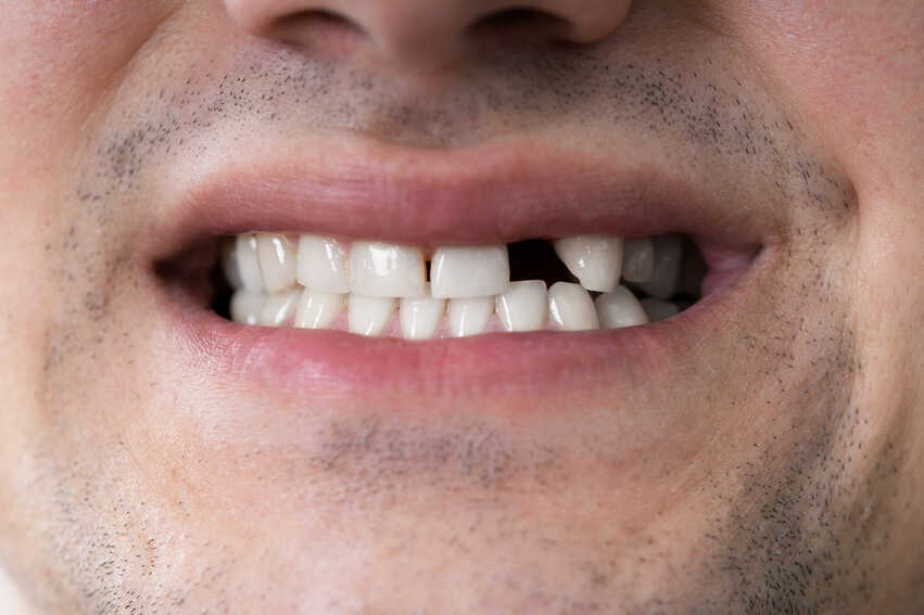 idősíthet a foghiány